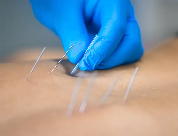 Dry Needling