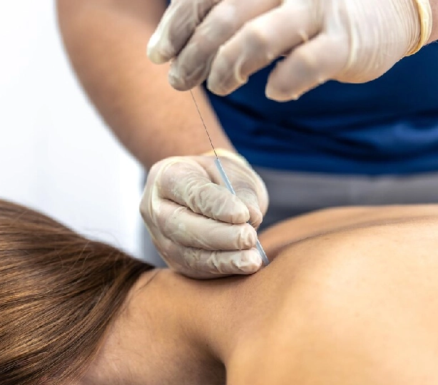 Benefit-Dry Needling Benefit-Dry Needling