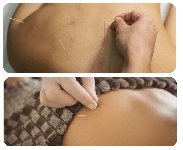 why choose us for Dry Needling Forest Hill why choose us for Dry Needling Forest Hill
