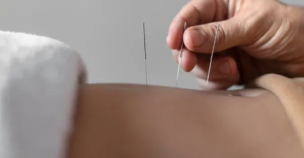 dry needling therapy dry needling therapy